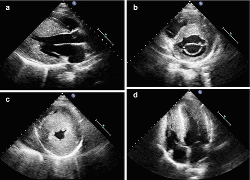 心电图q波异常能恢复吗_心脏异常q波_心脏q波异常