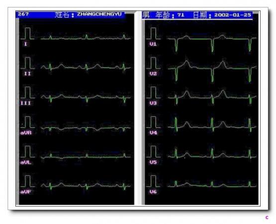 心电图q波异常能恢复吗_心脏q波异常_心脏异常q波